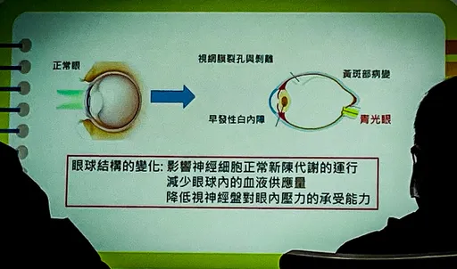 头痛到以为得脑瘤、下楼险踩空原来是青光眼惹的祸! 医点这三大原则要切记