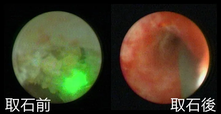 經由高功率鈥雷射擊碎結石，圖為治療前後對照。亞大附醫提供