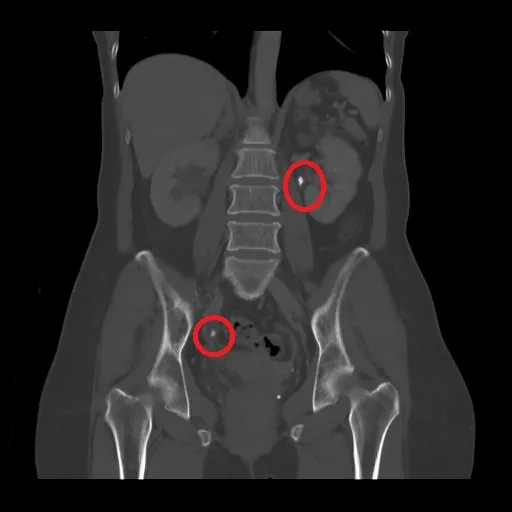 膀胱及腎臟結石(圖中紅圈處)。亞大附醫提供
