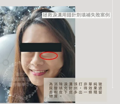 女子眼下長「毛毛蟲」 竟是填淚溝打到不純玻尿酸