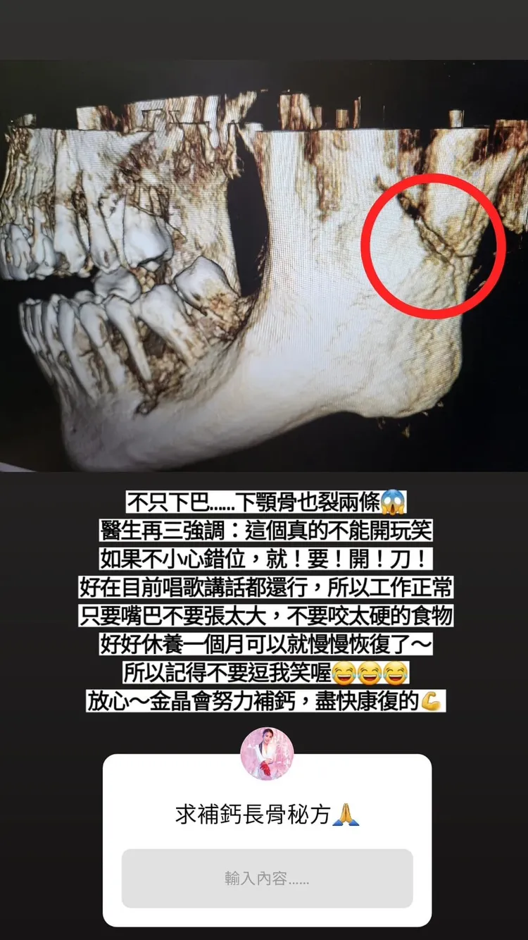 謝金晶的下顎骨裂成兩條。翻攝謝金晶IG限動