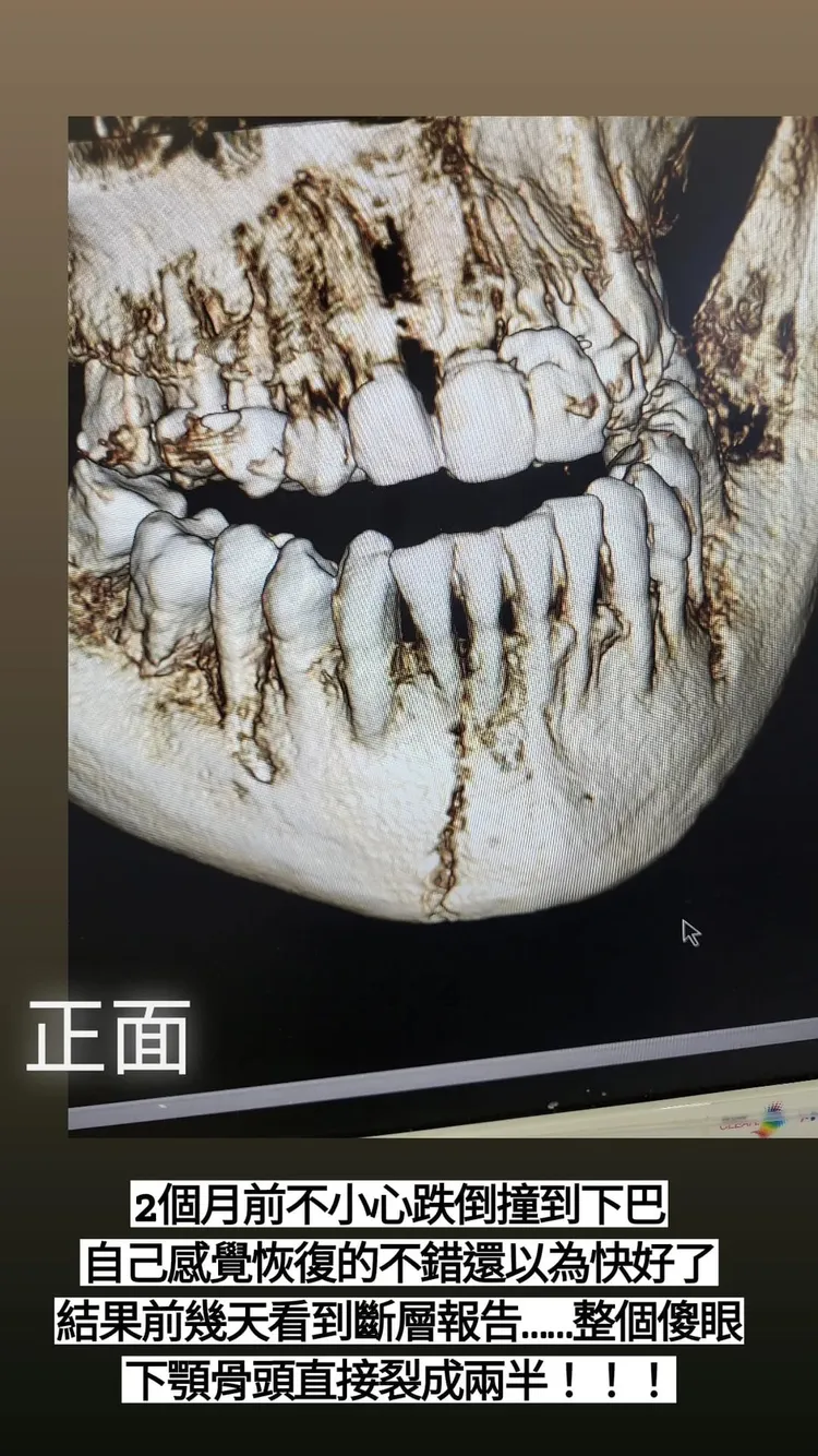 謝金晶的電腦斷層圖。翻攝謝金晶IG限動