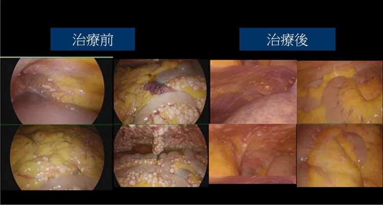 使用腹內溫熱化療治療與治療後3個月。三總提供