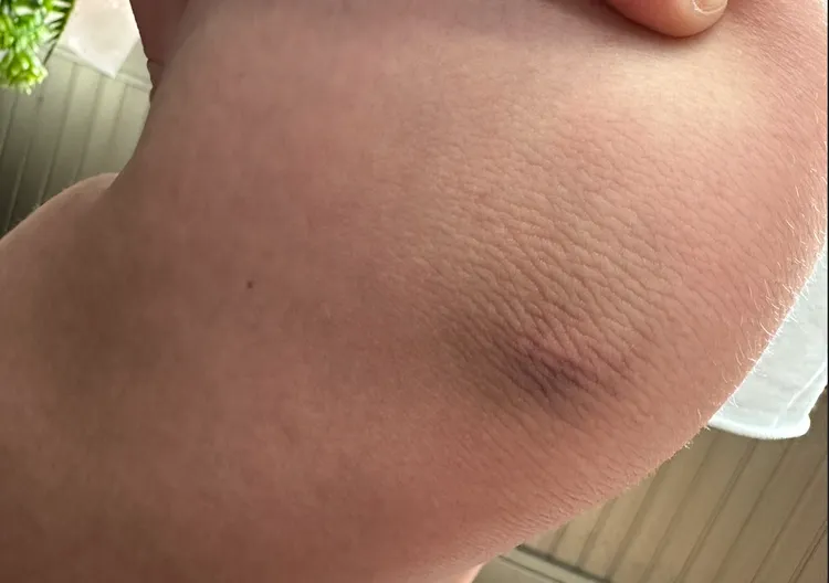 小六生膝蓋留下挫傷痕跡。江和樹提供