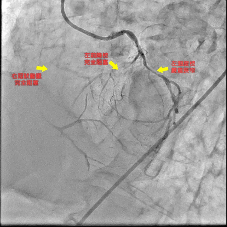 患者心臟冠狀動脈完全阻塞及嚴重狹窄情形。醫院提供