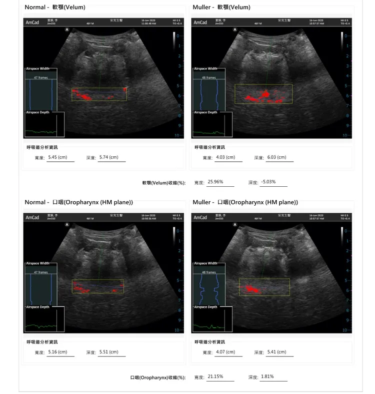 「AI上呼吸道檢測儀」以超音波掃描，並運用AI分析病兆位置。中國附醫提供