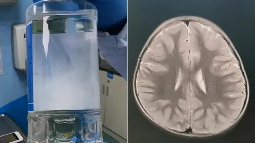 媽媽酒精擦身體幫她退燒 4歲女「急性酒精中毒」腦功能受損