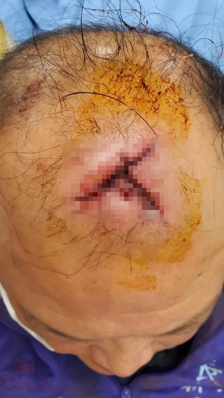 趙志成被打到頭破血流，送醫縫合。讀者提供