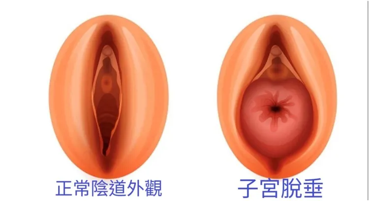 子宮脫垂示意圖。院方提供