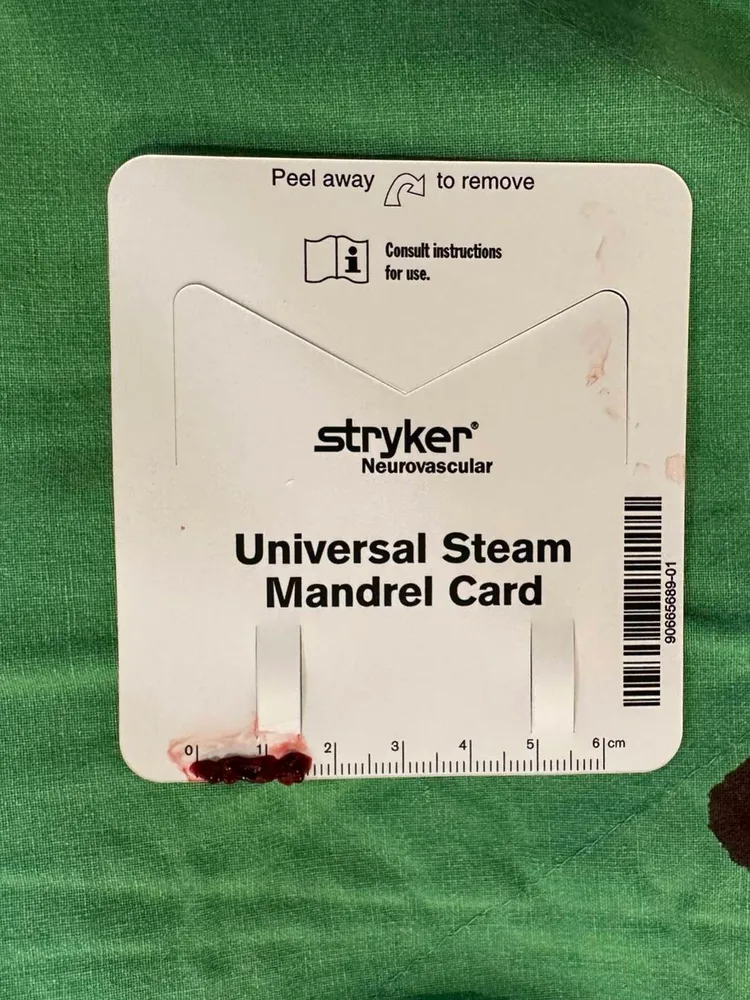 手術取出的血栓。院方提供