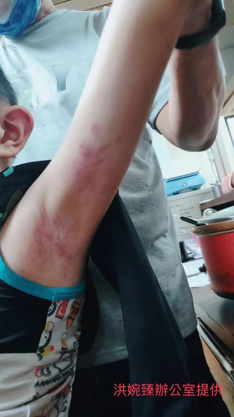 孩童雙臂受傷。洪婉臻辦公室提供