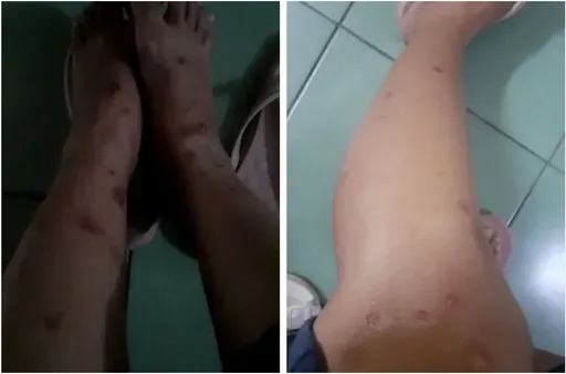 外籍看護「只在家顧阿嬤和買菜」還染猴痘? 羅一鈞說真相