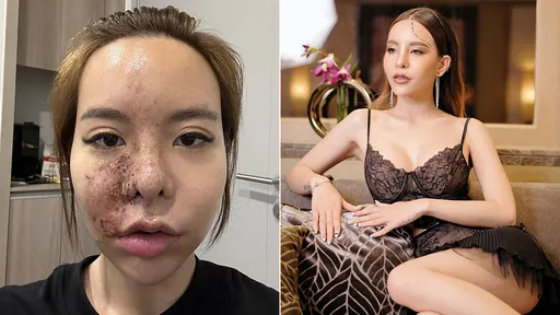 網美「整容變毀容」警世慘照曝光　哀號折磨一周瀕臨崩潰