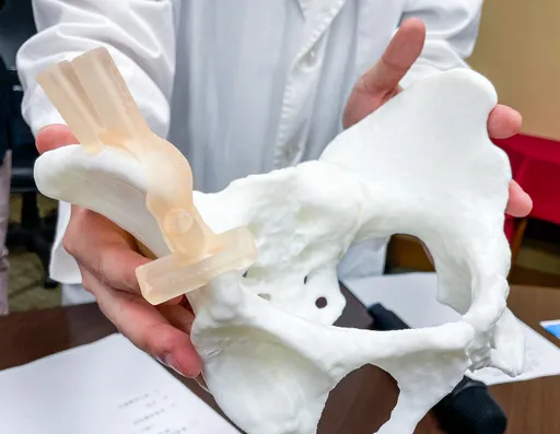 關節壓力比人大10倍!女大生得「這病」痛到不能睡 北榮超強手術幫她站起來