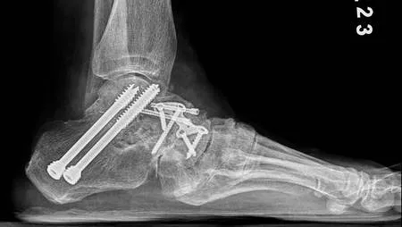 手術後X光影像。台北慈濟醫院提供