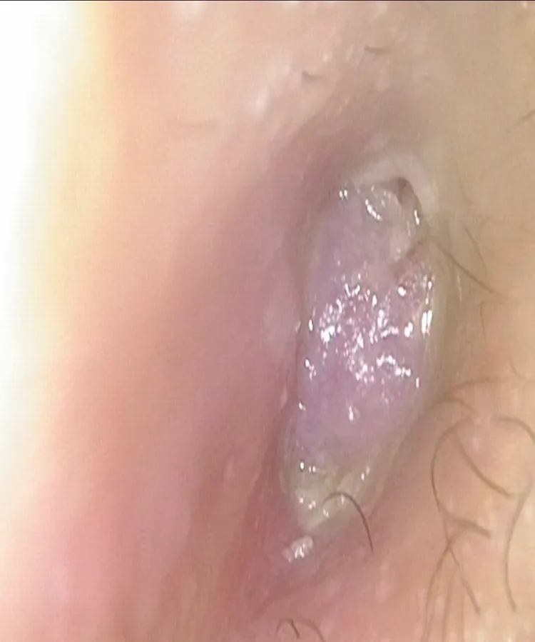 大叔因右耳道殘留棉花棒頭導致發炎，右耳道被粉紅肉芽組織填滿。楊顓謙醫師提供