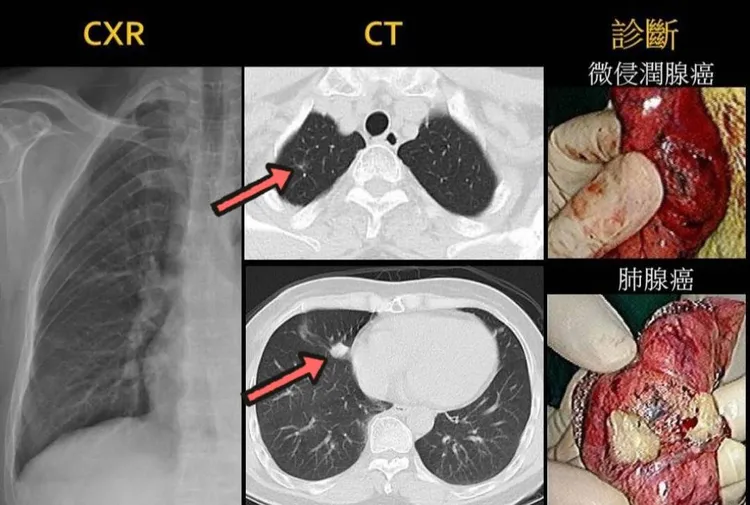 林阿嬤X光片無異常，斷層片顯現右中肺葉一顆1.2cm肺腺癌，右上肺葉一顆0.4cm微浸潤腺癌。阮綜合提供