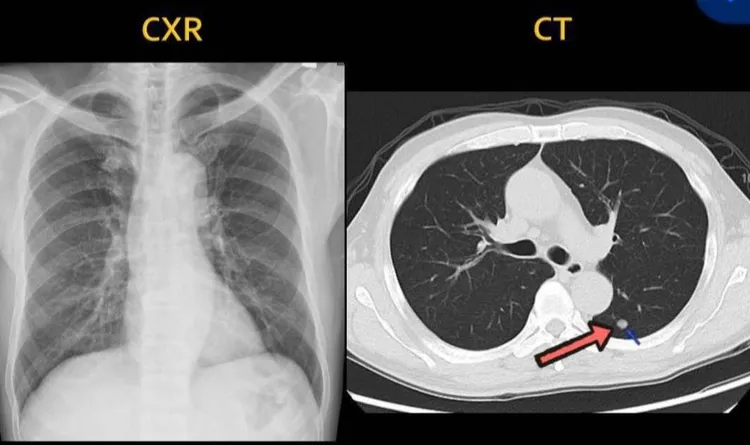 張先生X光片正常，斷層片有一顆肺結節。阮綜合提供