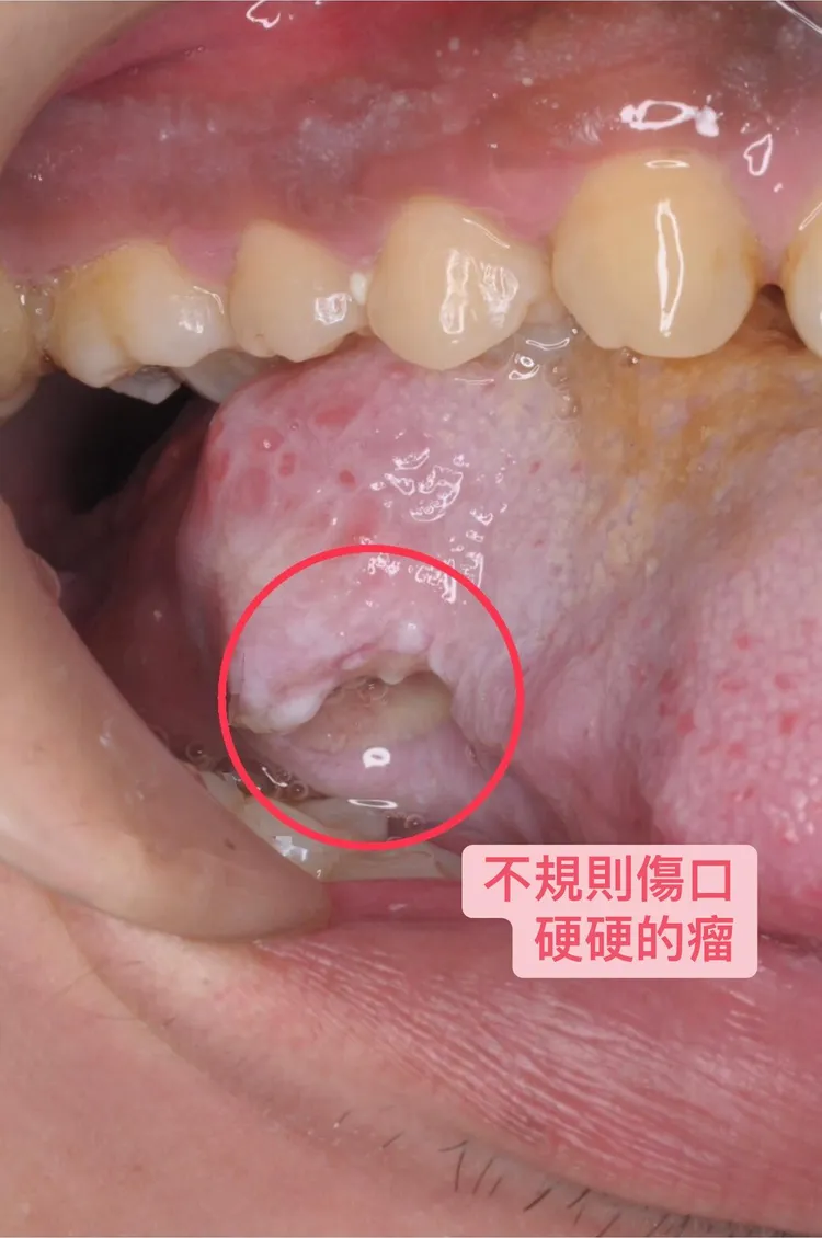 28歲男子舌頭「鋸齒狀」破皮好不了，就醫竟是舌癌。翻攝臉書「打開嘴巴說亮話 曹皓崴醫師」