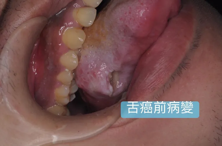 28歲男子舌頭「鋸齒狀」破皮好不了，就醫竟是舌癌。翻攝臉書「打開嘴巴說亮話 曹皓崴醫師」