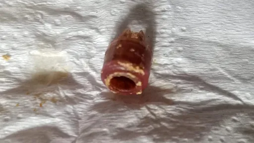 2歲童「鼻竇炎」10年治不好 內視鏡一看傻眼竟塞著筆芯