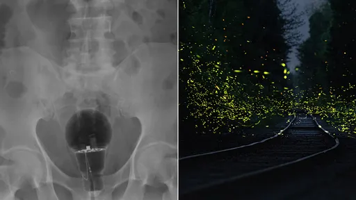 螢火蟲本人?他把「整顆燈泡塞體內」取不出 肛門痛到求助醫師