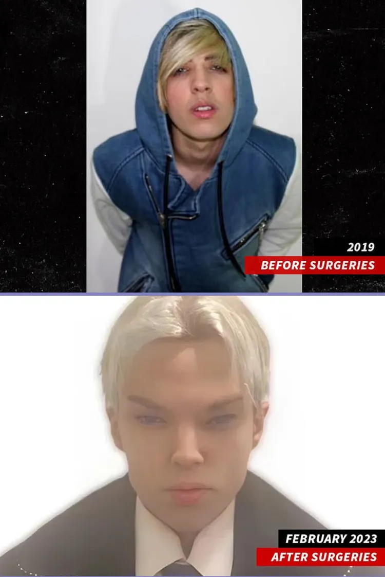 Colucci 2019年尚未動手術（上），與2023年2月動完手術的長相比一比。翻攝TMZ