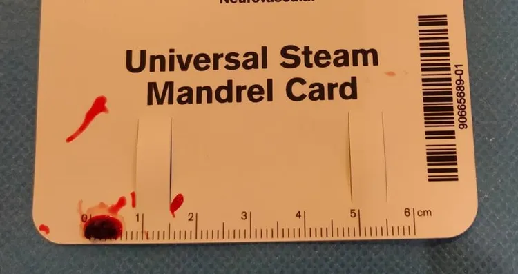 醫療團隊緊急完成顱內取拴術，順利取出阻塞在患者右側腦部血管中約0.6公分的血栓。亞大附醫提供