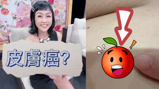 唐玲花400萬抗癌身體又冒異常變化　憂心皮膚癌急動刀