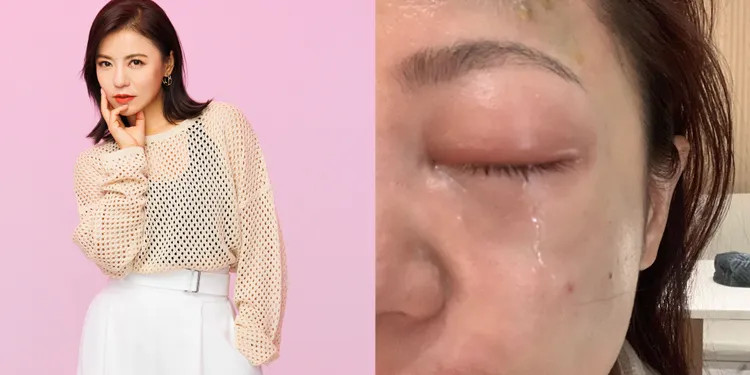 丁噹燙傷眼皮，眼睛腫到睜不開。相信提供