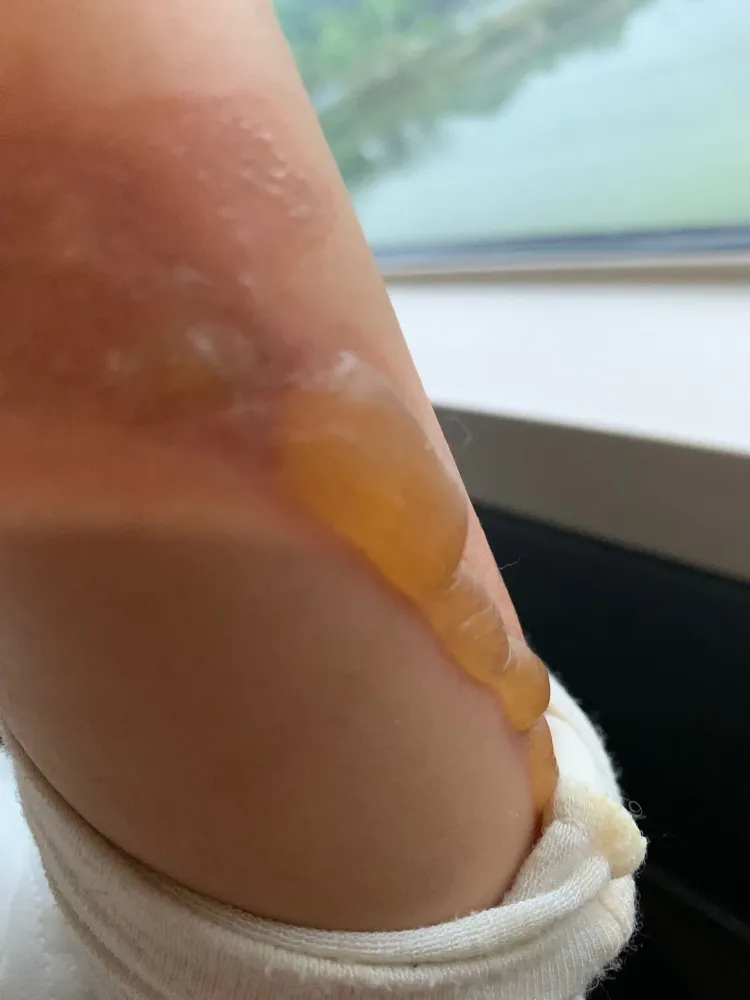 丁噹因操作破壁機錯誤，出意外被燙傷。相信提供
