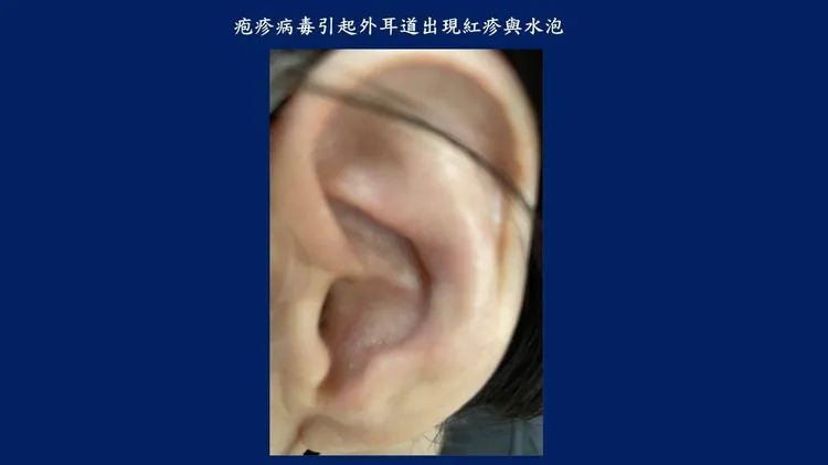 疱疹病毒會造成外耳道與耳後出現紅疹與水泡。書田診所提供