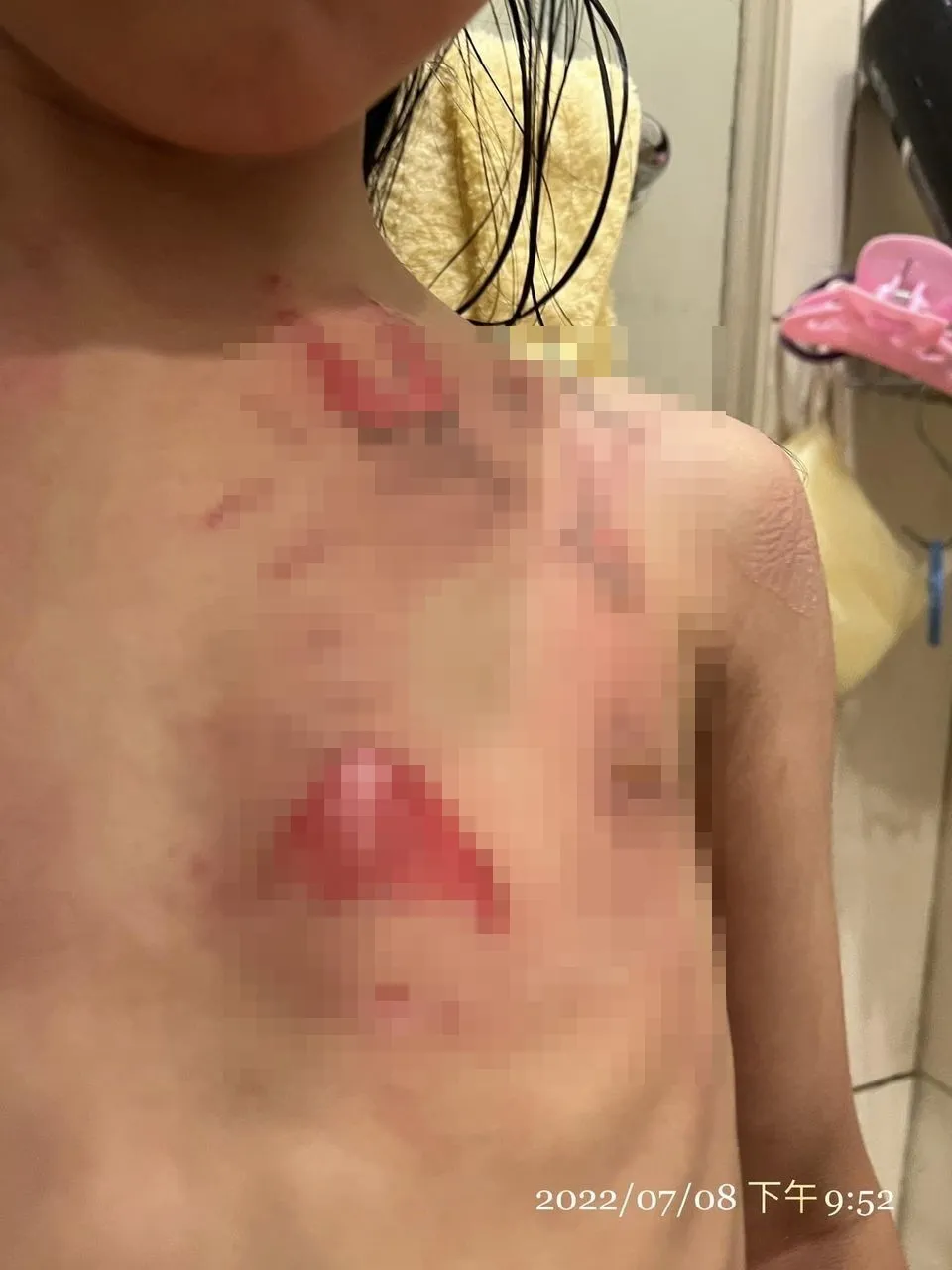 有家長指控5歲女兒在幼兒園內遭老師用熱水燙傷,事後園方延延送醫。翻攝臉書爆怨2公社