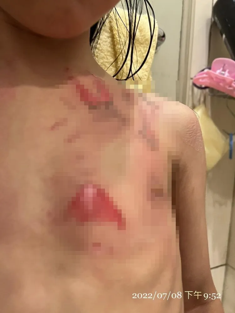 有家長指控5歲女兒在幼兒園內遭老師用熱水燙傷，事後園方延延送醫。翻攝臉書爆怨2公社