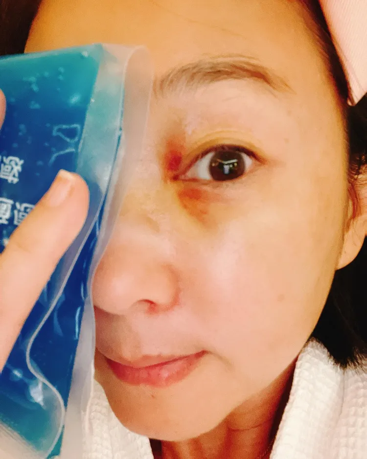 六月臉撞石頭，幸好骨頭沒受傷。翻攝六月臉書