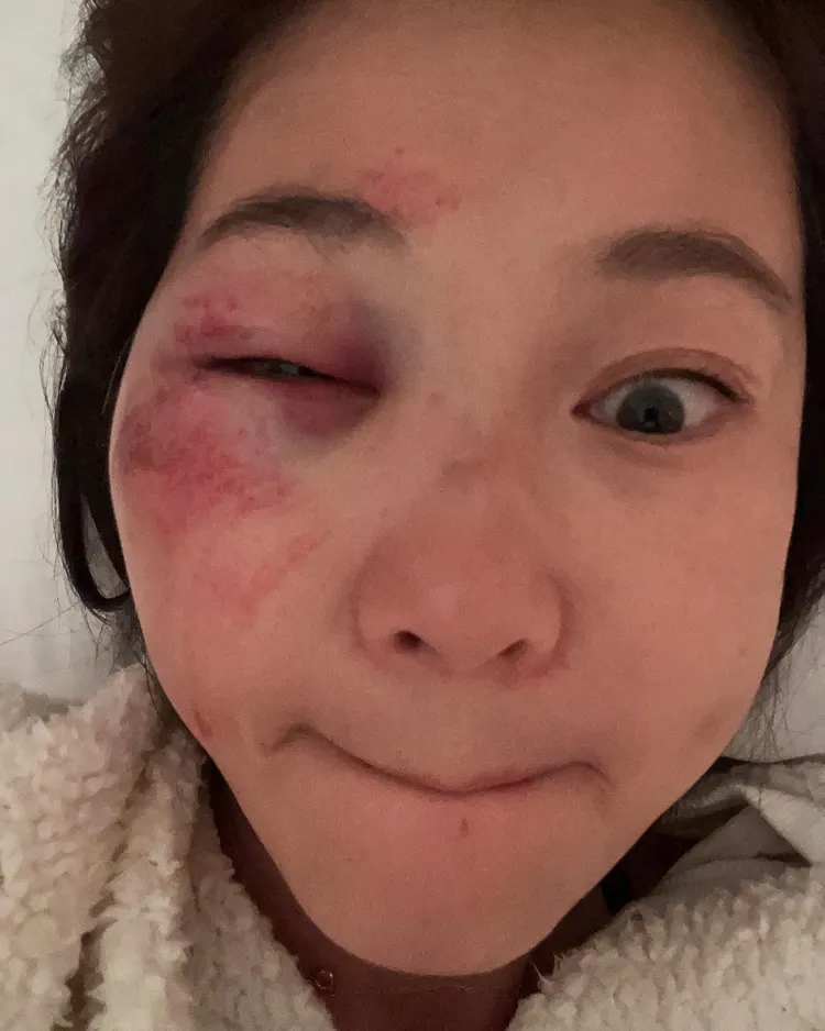 六月跌倒傷勢令人心疼。翻攝六月臉書