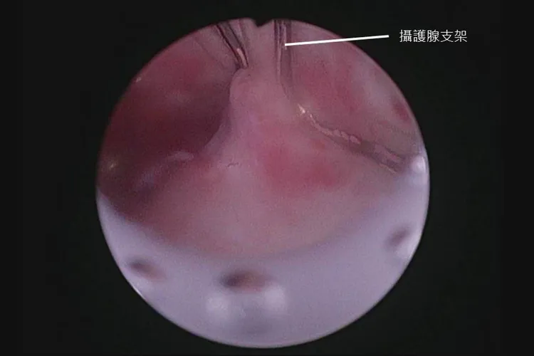 張先生放置攝護腺支架後排尿恢復順暢。書田診所提供