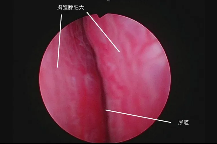 張先生的攝護腺已增生肥大至約110c.c。書田診所提供