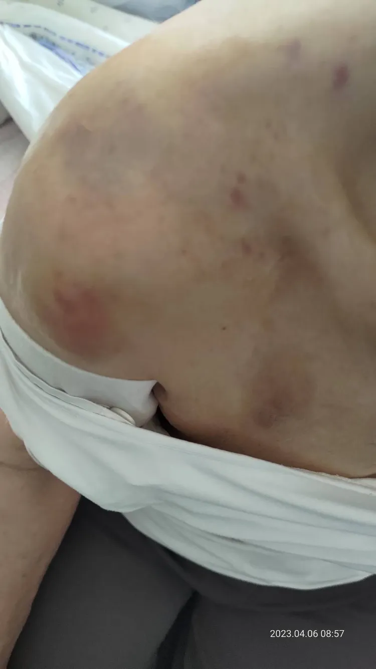 許姓阿嬤被砸到身體多處瘀青。讀者提供