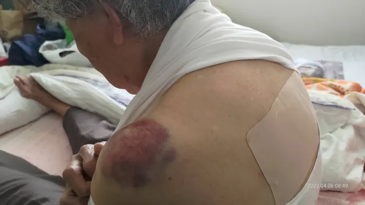 許姓阿嬤被砸到身體多處瘀青。讀者提供