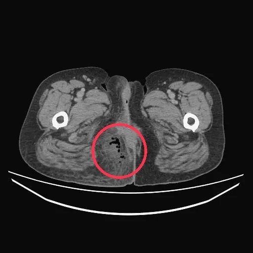 阿秀因魚刺卡進肛門組織，導致周邊發炎潰爛。台中醫院提供