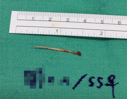 妇人误吞鱼刺卡肛门 痛不欲生!医吁「这类人」进食一定要注意