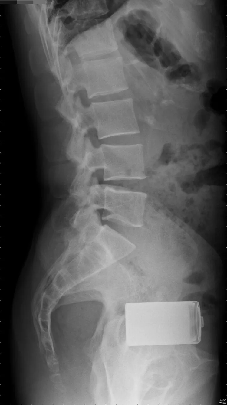 X光片顯示，男子肛門裡的直腸處有顆電池。蔡鎧隆醫師提供