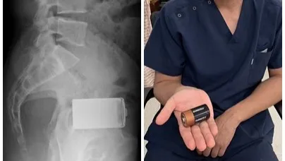 獨家|肚裡有異物!他竟拿掃把插入肛門挖出來 腸被刺破腹膜炎險死