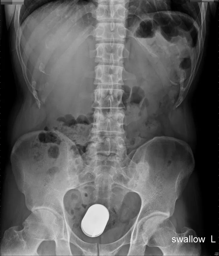 X光片顯示，男子肛門裡的直腸處有顆電池。蔡鎧隆醫師提供