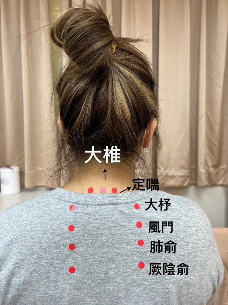 三伏貼穴位。北市聯醫提供