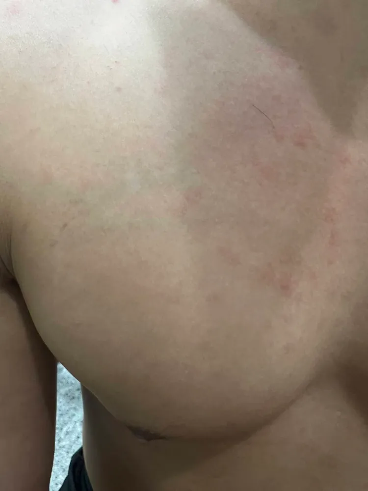 梅毒患者身體可能會有冒出紅疹的病徵。蘇信豪醫師提供