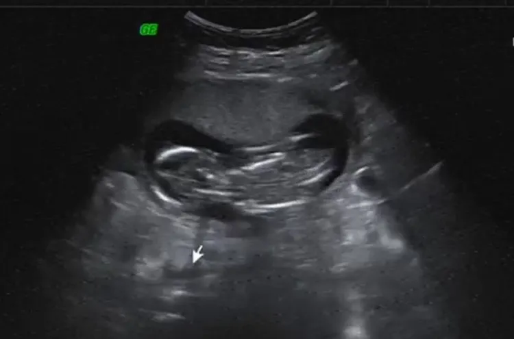 葉家妤秀胎兒超音波照。民視提供