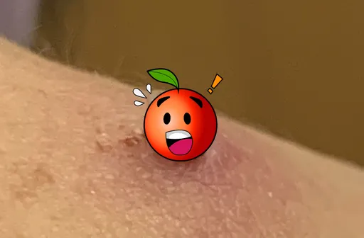 獨家|從日本回來肩痛十多天 她就醫抓出一隻蟲!醫憂引發「萊姆病」