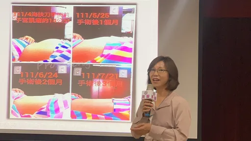 大腹便便如孕婦 海扶治療消融肌瘤!重回輕盈體態